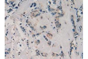 Detection of aZGP1 in Human Breast Cancer Tissue using Polyclonal Antibody to Alpha-2-Glycoprotein 1, Zinc Binding (aZGP1) (AZGP1 antibody  (AA 180-298))
