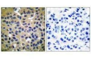 Immunohistochemical analysis of paraffin-embedded human breast carcinoma tissue using Collagen II antibody. (COL2A1 antibody)