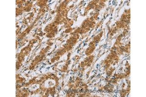 Immunohistochemistry of Human gastric cancer using CYP2E1 Polyclonal Antibody at dilution of 1:30 (CYP2E1 antibody)