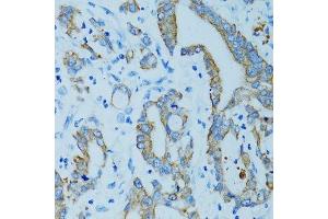 Immunohistochemistry of paraffin-embedded human colon carcinoma using KRT15 antibody. (KRT15 antibody)