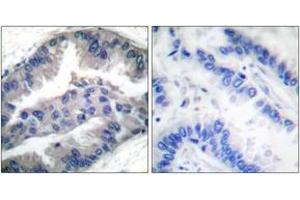 Immunohistochemistry analysis of paraffin-embedded human lung carcinoma, using BIK (Phospho-Thr33) Antibody. (BIK antibody  (pThr33))