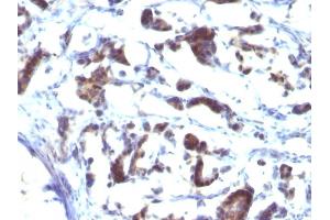 Formalin-fixed, paraffin-embedded human Gastric Carcinoma stained with ZFYVE28 Mouse Monoclonal Antibody (LST2/2426) (ZFYVE28 antibody)
