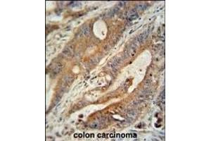 ZBBX antibody (N-term) (ABIN654386 and ABIN2844132) immunohistochemistry analysis in formalin fixed and paraffin embedded human colon carcinoma followed by peroxidase conjugation of the secondary antibody and DAB staining. (ZBBX antibody  (N-Term))