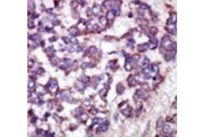 IHC analysis of FFPE human hepatocarcinoma tissue stained with the LATS1 antibody (LATS1 antibody  (AA 1-30))