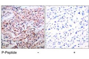Immunohistochemical analysis of paraffin-embedded human breast carcinoma tissue using BCL2 (phospho T56) polyclonal antibody . (Bcl-2 antibody  (pThr56))