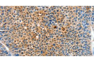Immunohistochemistry of paraffin-embedded Human liver cancer tissue using SERPINF2 Polyclonal Antibody at dilution 1:50 (alpha 2 Antiplasmin antibody)