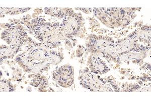Detection of ACO1 in Human Lung cancer Tissue using Polyclonal Antibody to Aconitase 1 (ACO1) (Aconitase 1 antibody  (AA 251-443))