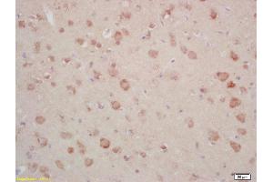 Formalin-fixed and paraffin embedded human gastric carcinoma labeled with Rabbit Anti Annexin A13 Polyclonal Antibody, Unconjugated (ABIN1714416) at 1:200 followed by conjugation to the secondary antibody and DAB staining (CRY1 antibody)