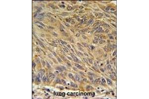 CD99L2 Antibody (Center) (ABIN651686 and ABIN2840361) immunohistochemistry analysis in formalin fixed and paraffin embedded human lung carcinoma followed by peroxidase conjugation of the secondary antibody and DAB staining. (CD99L2 antibody  (AA 39-66))