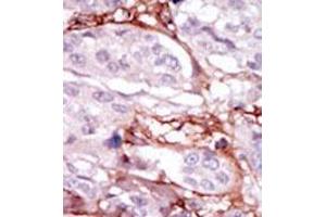 Formalin-fixed and paraffin-embedded human cancer tissue (breast carcinoma) reacted with the primary antibody, which was peroxidase-conjugated to the secondary antibody, followed by DAB staining. (STK31 antibody  (N-Term))