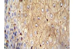 Beta-Actin antibody immunohistochemistry analysis in formalin fixed and paraffin embedded human esophageal carcinoma.