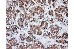 Immunohistochemical staining of paraffin-embedded Carcinoma of liver tissue using anti-VAT1L mouse monoclonal antibody. (VAT1L antibody)
