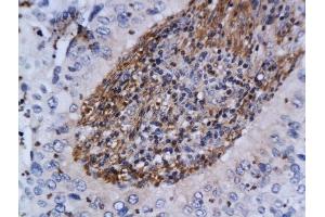 Formalin-fixed and paraffin embedded human cervical cancer labeled with Anti-ATM Polyclonal Antibody, Unconjugated (ABIN685582) at 1:200 followed by conjugation to the secondary antibody and DAB staining (ATM antibody  (AA 2681-2750))