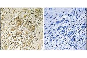 Immunohistochemistry analysis of paraffin-embedded human breast carcinoma, using IRS-1 (Phospho-Ser639) Antibody. (IRS1 antibody  (pSer639))
