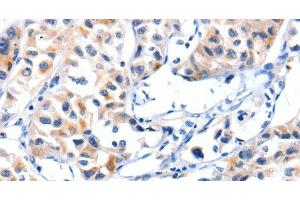 Immunohistochemistry of paraffin-embedded Human lung cancer tissue using Fibulin 5 Polyclonal Antibody at dilution 1:85 (Fibulin 5 antibody)