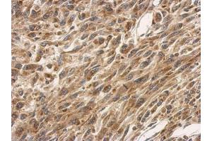 IHC-P Image Immunohistochemical analysis of paraffin-embedded U87 xenograft, using SLC25A11, antibody at 1:500 dilution. (SLC25A11 antibody)