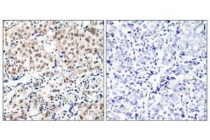 Immunohistochemical analysis of paraffin-embedded human breast carcinoma tissue using p27Kip1(Phospho-Thr187) Antibody(left) or the same antibody preincubated with blocking peptide(right). (CDKN1B antibody  (pThr187))