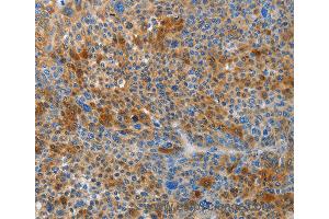 Immunohistochemistry of Human liver cancer using HTRA3 Polyclonal Antibody at dilution of 1:45 (HTRA3 antibody)