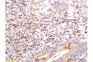 Formalin-fixed and paraffin embedded human colon labeled with Anti SLC26A4 Polyclonal Antibody, Unconjugated (ABIN721030) followed by conjugation to the secondary antibody and DAB staining