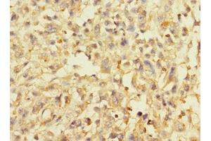 Immunohistochemistry of paraffin-embedded human melanoma using ABIN7144587 at dilution of 1:100 (AVPI1 antibody  (AA 1-147))