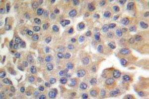 Immunohistochemical analysis of paraffin-embedded human breast cancer tissue using FYN polyclonal antibody . (FYN antibody)