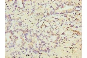 Immunohistochemistry of paraffin-embedded human lung cancer using ABIN7175372 at dilution of 1:100 (VEGFC antibody  (AA 112-227))