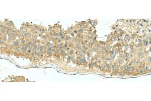 Immunohistochemistry of paraffin-embedded Human liver cancer tissue using KIR2DL5A Polyclonal Antibody at dilution of 1:40(x200) (KIR2DL5A antibody)