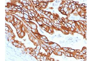 Formalin-fixed, paraffin-embedded human Colon Carcinoma stained with CK18 Rabbit Recombinant Monoclonal Antibody (KRT18/2808R). (Recombinant Cytokeratin 18 antibody)