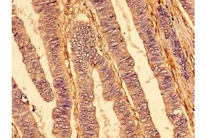 IHC image of ABIN7173825 diluted at 1:400 and staining in paraffin-embedded human colon cancer performed on a Leica BondTM system. (TNFRSF1A antibody  (AA 263-468))