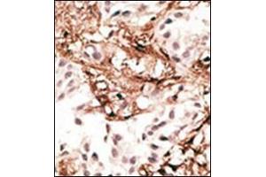 Formalin-fixed and paraffin-embedded human cancer tissue reacted with the primary antibody, which was peroxidase-conjugated to the secondary antibody, followed by AEC staining. (LC3C antibody  (N-Term))