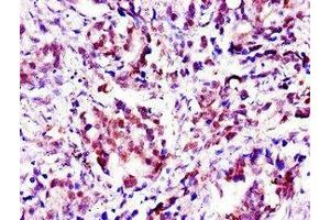 Immunohistochemistry of paraffin-embedded human gastric cancer using ABIN7144491 at dilution of 1:100 (Aprataxin antibody  (AA 92-161))