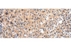 Immunohistochemistry of paraffin-embedded Human liver cancer tissue using GLT8D1 Polyclonal Antibody at dilution of 1:90(x200) (GLT8D1 antibody)