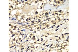Immunohistochemistry of paraffin-embedded Human kidney cancer using ZNF169 Polyclonal Antibody at dilution of 1:100 (40x lens). (ZNF169 antibody)