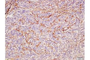 Formalin-fixed and paraffin embedded human gastric carcinoma labeled with Rabbit Anti-CADM2 Polyclonal Antibody, Unconjugated (ABIN1386792) at 1:200 followed by conjugation to the secondary antibody and DAB staining