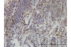 Immunoperoxidase of monoclonal antibody to MTHFD2 on formalin-fixed paraffin-embedded human lymphoma tissue. (MTHFD2 antibody  (AA 16-344))