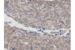 Detection of MRPL1 in Human Lung cancer Tissue using Polyclonal Antibody to Mitochondrial Ribosomal Protein L1 (MRPL1) (MRPL1 antibody  (AA 147-285))