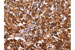 The image on the left is immunohistochemistry of paraffin-embedded Human thyroid cancer tissue using ABIN7128511(ARL4A Antibody) at dilution 1/50, on the right is treated with fusion protein.