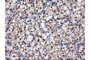 Immunohistochemical staining of paraffin-embedded Carcinoma of Human kidney tissue using anti-SERPINB6 mouse monoclonal antibody.