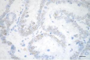 Immunohistochemistry was performed on paraffin-embedded human ovarian carcinoma using chromodomain helicase DNA binding protein 3 antibody (ABIN7798069), 1:200). (Recombinant CHD3 antibody)