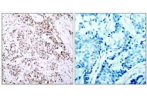 Immunohistochemical analysis of paraffin- embedded human breast carcinoma tissue using Estrogen Receptor-α (Ab-106) antibody (E021066). (Estrogen Receptor alpha antibody)