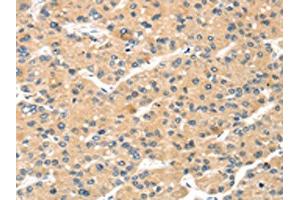 The image on the left is immunohistochemistry of paraffin-embedded Human liver cancer tissue using ABIN7191340(MAGEA11 Antibody) at dilution 1/20, on the right is treated with synthetic peptide. (MAGEA11 antibody)