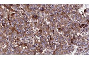 ABIN6277713 at 1/100 staining Human liver cancer tissue by IHC-P. (ATP1B1 antibody  (Internal Region))