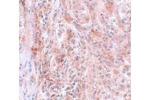 Immunohistochemical staining of human breast cancer tissue with BCAS2 polyclonal antibody  at 5 ug/mL dilution. (BCAS2 antibody  (C-Term))