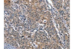 The image on the left is immunohistochemistry of paraffin-embedded Human gastric cancer tissue using ABIN7191907(PLA2G6 Antibody) at dilution 1/15, on the right is treated with synthetic peptide. (PLA2G6 antibody)