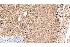 Immunohistochemistry of paraffin-embedded Human liver cancer tissue using IDE Monoclonal Antibody at dilution of 1:200. (IDE antibody)