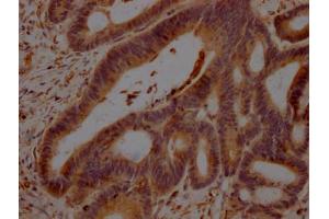 IHC image of ABIN7154537 diluted at 1:100 and staining in paraffin-embedded human colon cancer performed on a Leica BondTM system.
