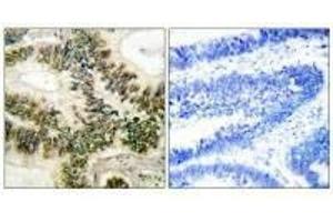 Immunohistochemical analysis of paraffin-embedded human colon carcinoma tissue using Cyclin E1 (Ab-395) antibody. (Cyclin E1 antibody  (Thr395))