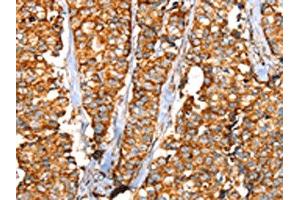 The image on the left is immunohistochemistry of paraffin-embedded Human breast cancer tissue using ABIN7192442(SLC25A3 Antibody) at dilution 1/35, on the right is treated with synthetic peptide. (SLC25A3 antibody)