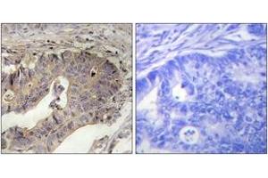 Immunohistochemistry analysis of paraffin-embedded human breast carcinoma tissue, using Fibrillin-1 Antibody. (Fibrillin 1 antibody  (AA 2811-2860))