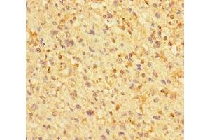 Immunohistochemistry of paraffin-embedded human glioma using ABIN7176271 at dilution of 1:100 (ZNF384 antibody  (AA 1-245))